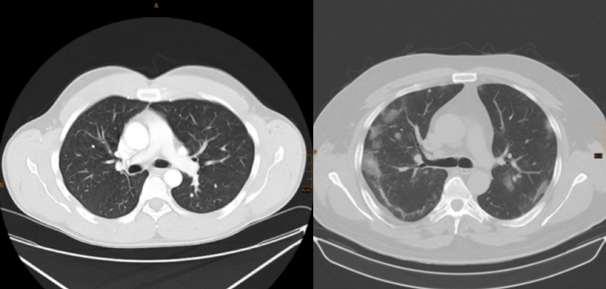 Abbildung 2: Computertomogramm einer gesunden Lunge (links) im Vergleich zu einer Lunge mit Infiltraten durch CoViD19 (rechts) mit mehreren fleckigen und streifigen Verdichtungen.
